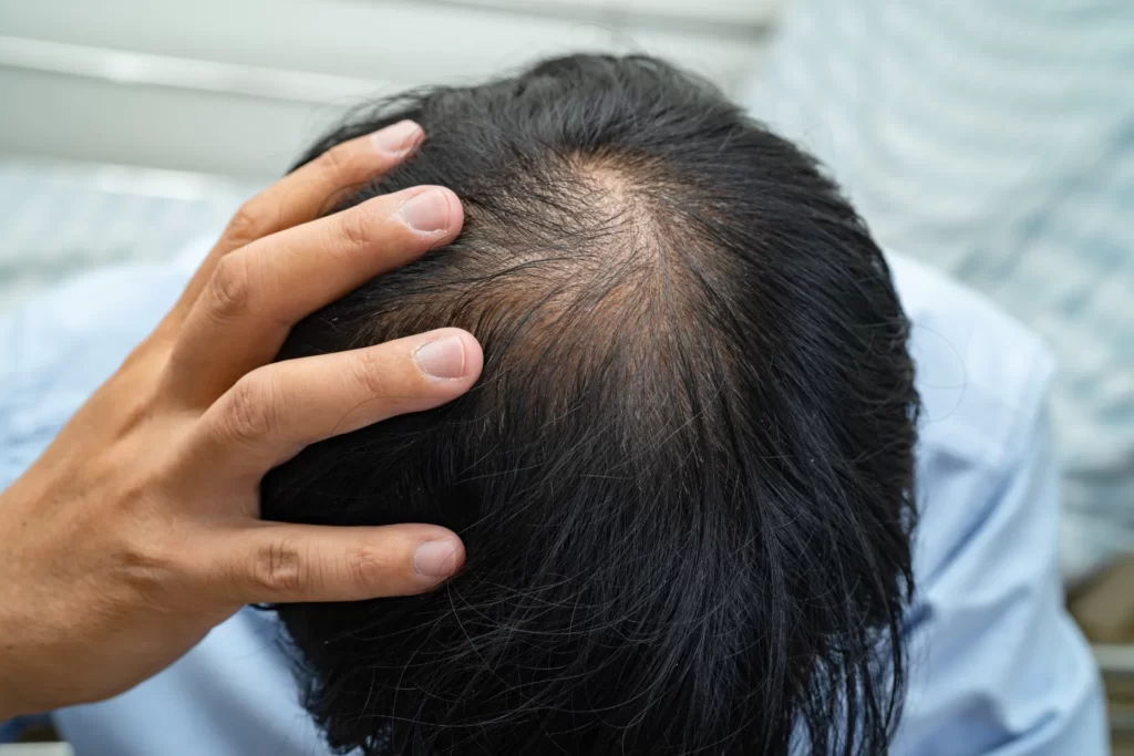bald in the middle head and begin no loss hair gla utc